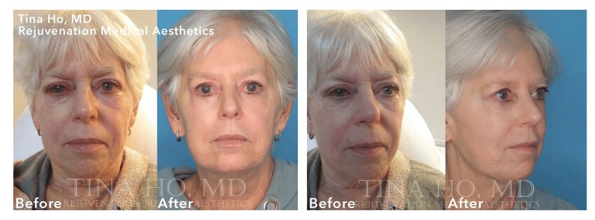 newtown liquid facelift patient before and after results