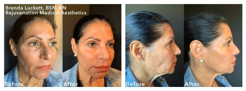 newtown liquid facelift patient before and after results