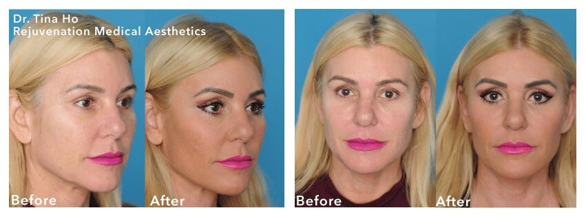 newtown liquid facelift patient before and after results