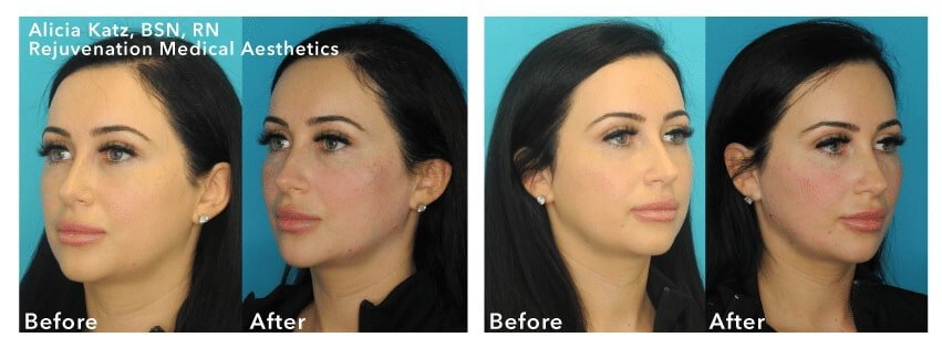 newtown liquid facelift patient results