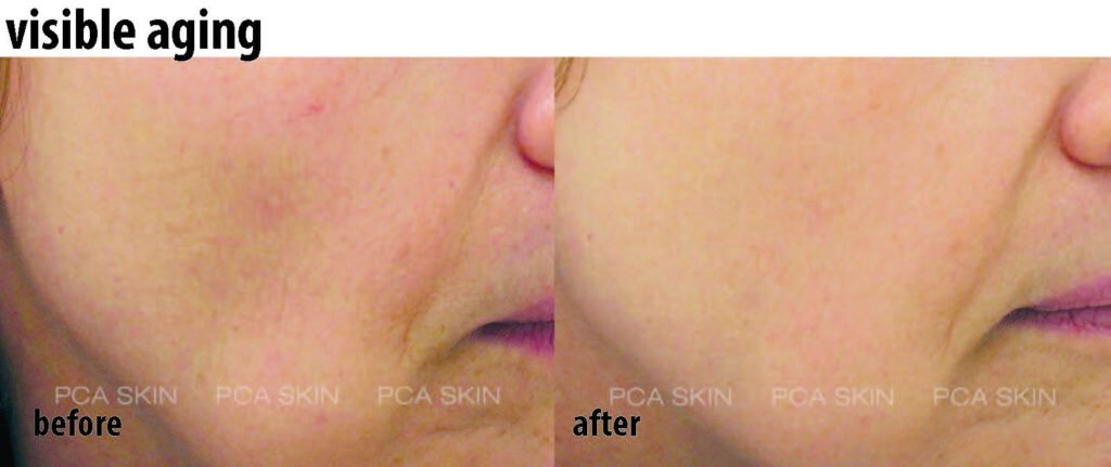 Newtown chemical peel patient before and after