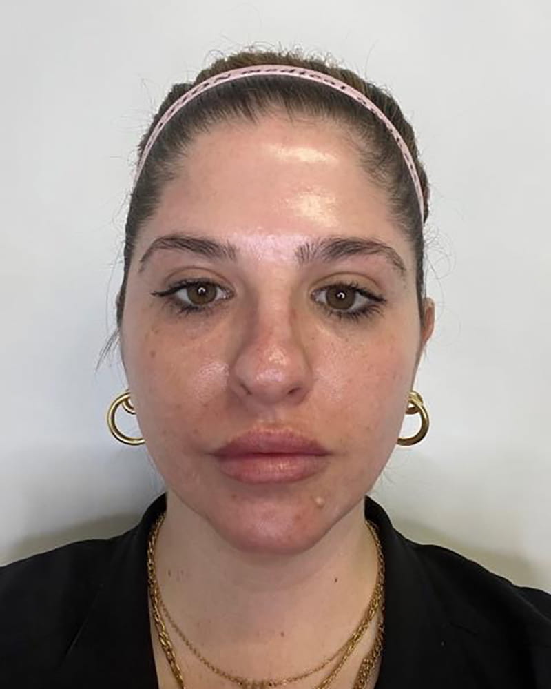 Real CO2 Resurfacing Laser patient after procedure