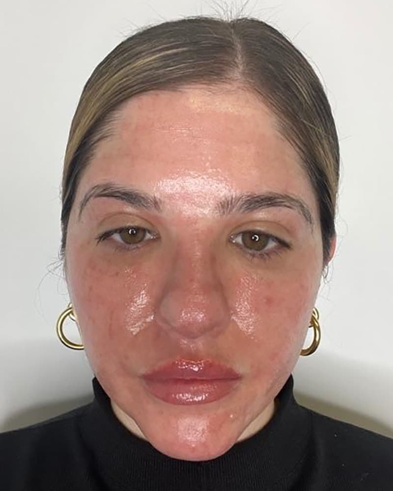Real CO2 Resurfacing Laser 4 days after the procedure