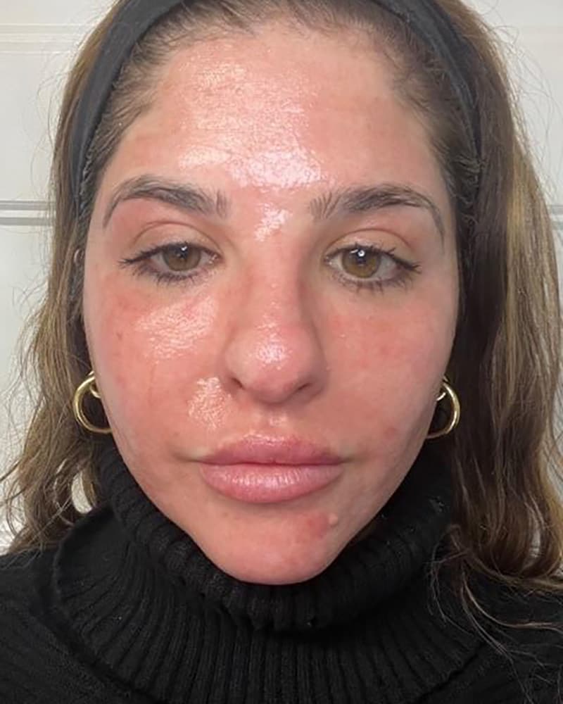 Real CO2 Resurfacing Laser patient 5 days after the procedure