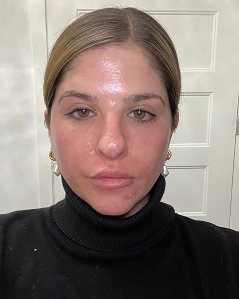 Real CO2 Resurfacing Laser patient 6 days after the procedure
