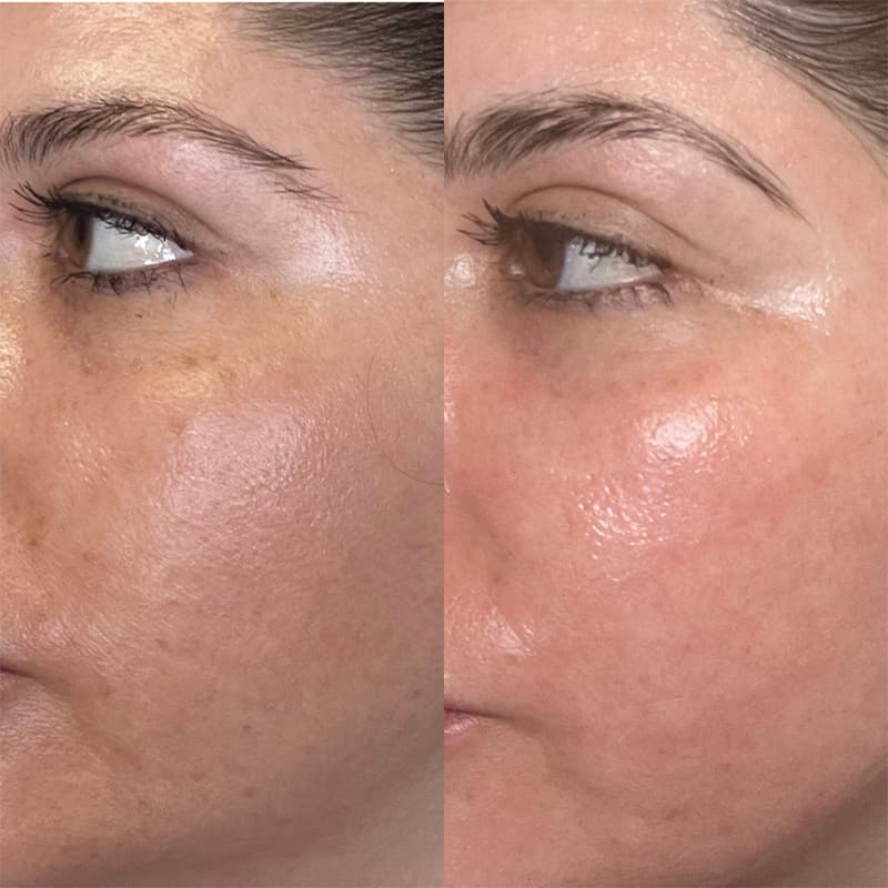 Real CO2 Resurfacing Laser patient before and after