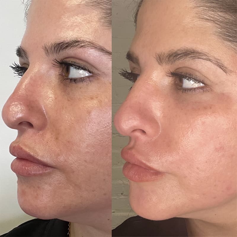 Real CO2 Resurfacing Laser patient 10 days after procedure before and after