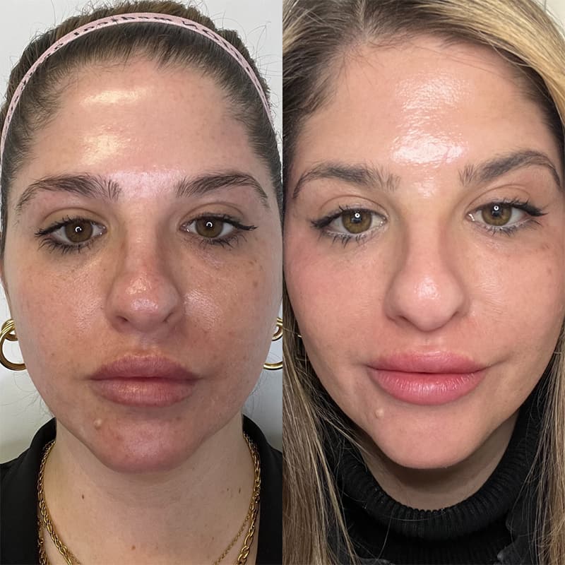 Real CO2 Resurfacing Laser patient final before and after