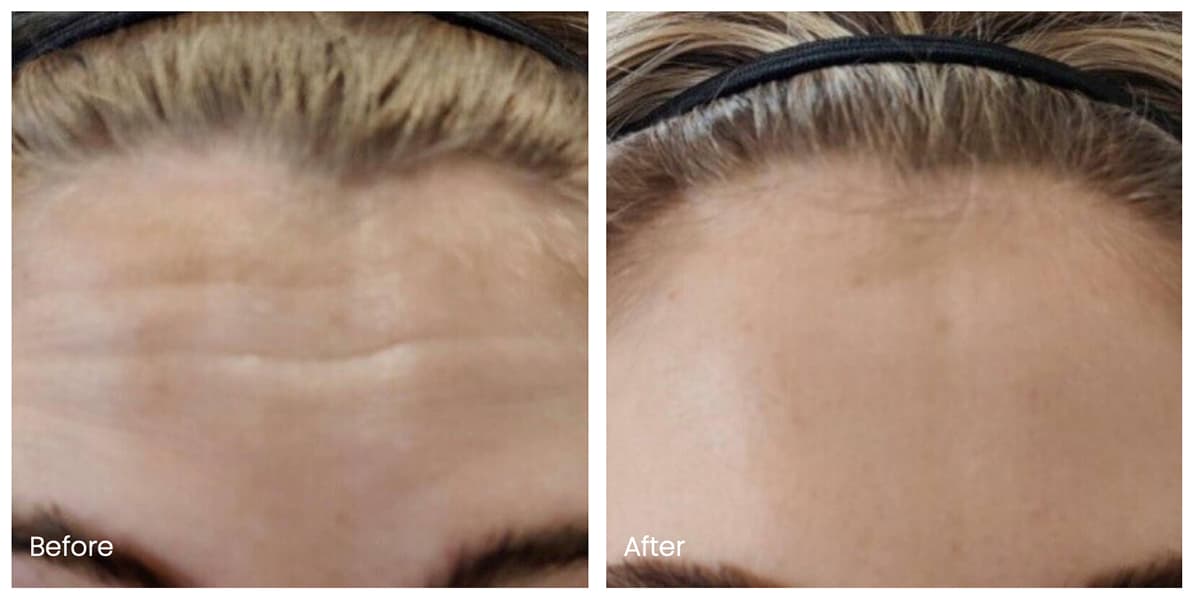 Real Botox patient before and after