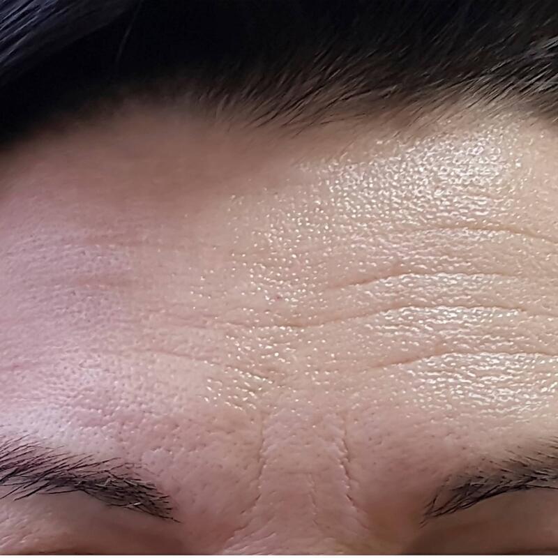 Botox Before & After Image