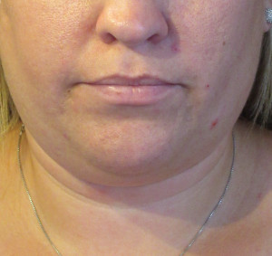 CoolSculpting Before & After Image