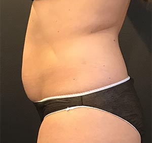 CoolSculpting Before & After Image