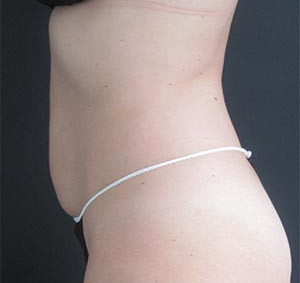 CoolSculpting Before & After Image