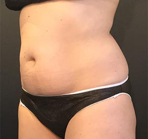 CoolSculpting Before & After Image