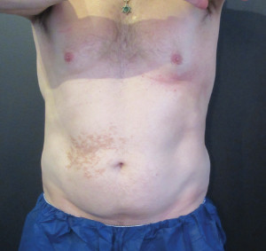 CoolSculpting Before & After Image