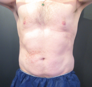 CoolSculpting Before & After Image