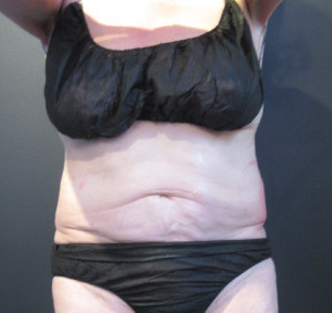 CoolSculpting Before & After Image