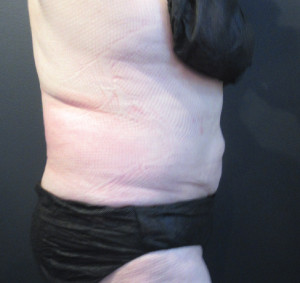 CoolSculpting Before & After Image