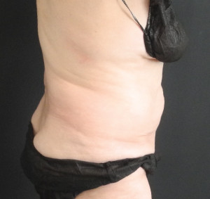 CoolSculpting Before & After Image