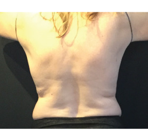 CoolSculpting Before & After Image