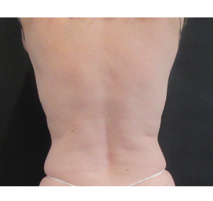 CoolSculpting Before & After Image