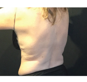 CoolSculpting Before & After Image