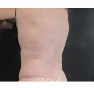 CoolSculpting Before & After Image