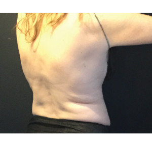 CoolSculpting Before & After Image