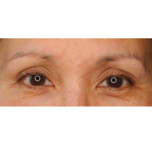 Eyebrows Before & After Image