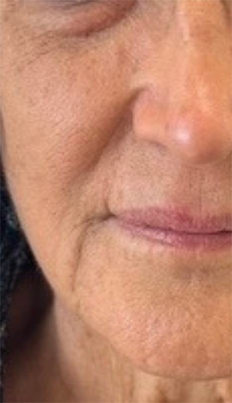 Fillers Before & After Image