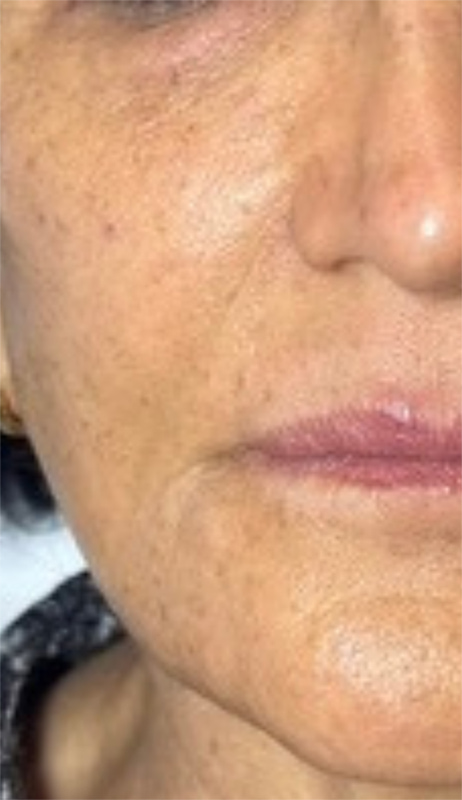 Fillers Before & After Image