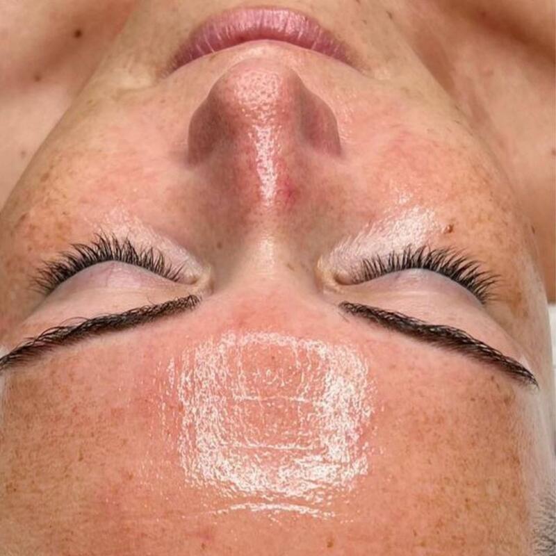 Hydrafacial Before & After Image