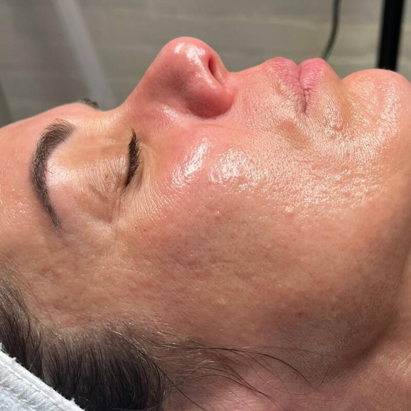 Hydrafacial Before & After Image