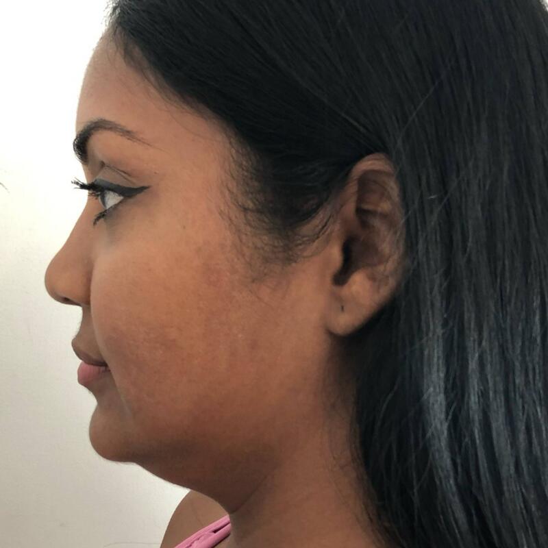 Kybella Before & After Image