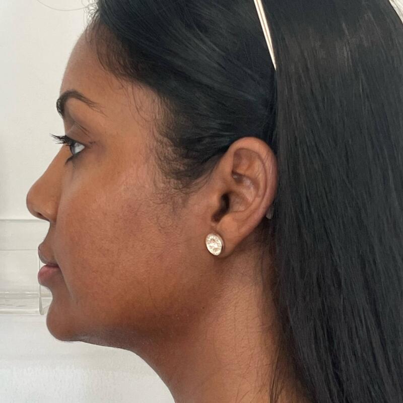 Kybella Before & After Image