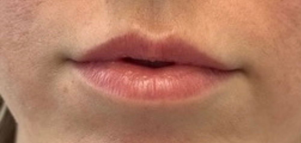 Lips Before & After Image