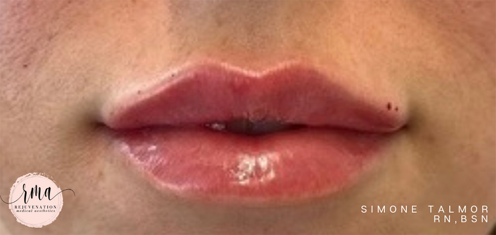 Lips Before & After Image