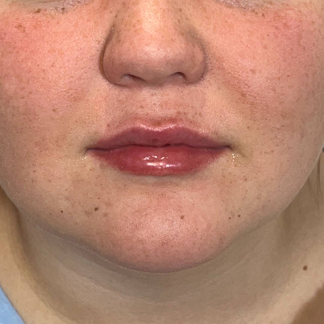 Lips Before & After Image