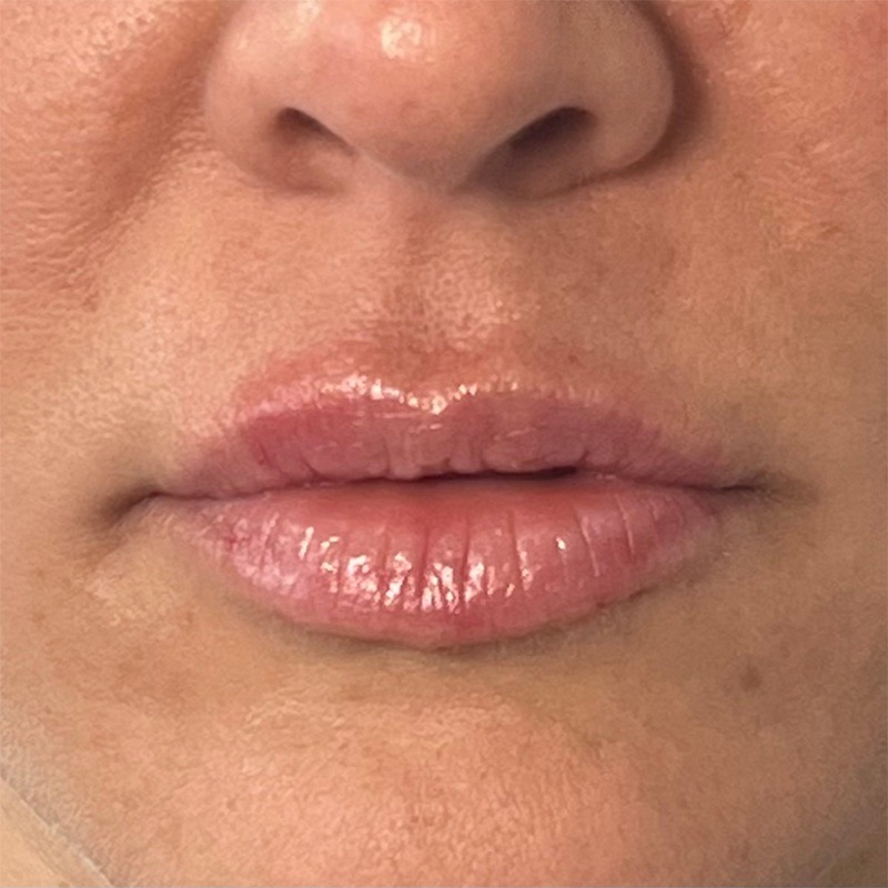 Lips Before & After Image