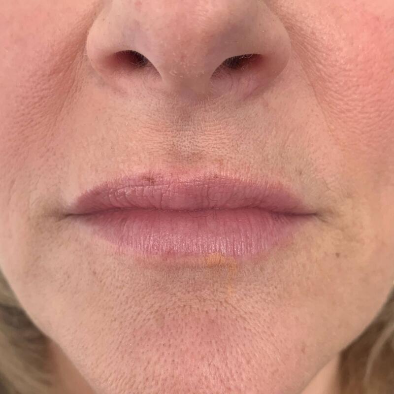 Lips Before & After Image