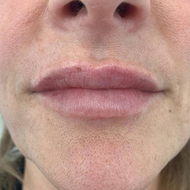 Lips Before & After Image