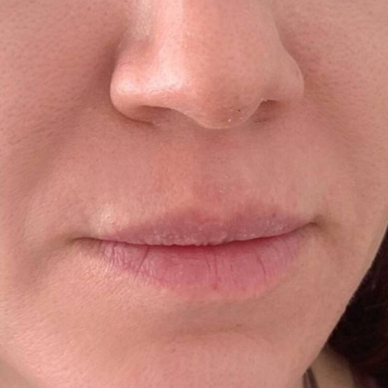 Lips Before & After Image