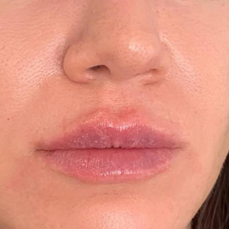 Lips Before & After Image