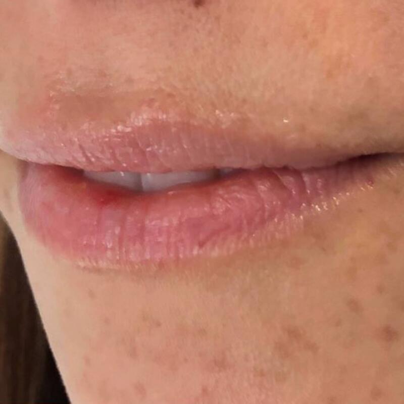 Lips Before & After Image