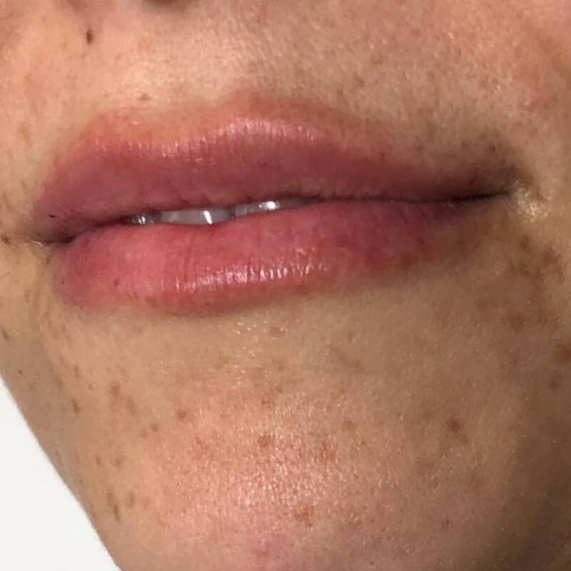 Lips Before & After Image