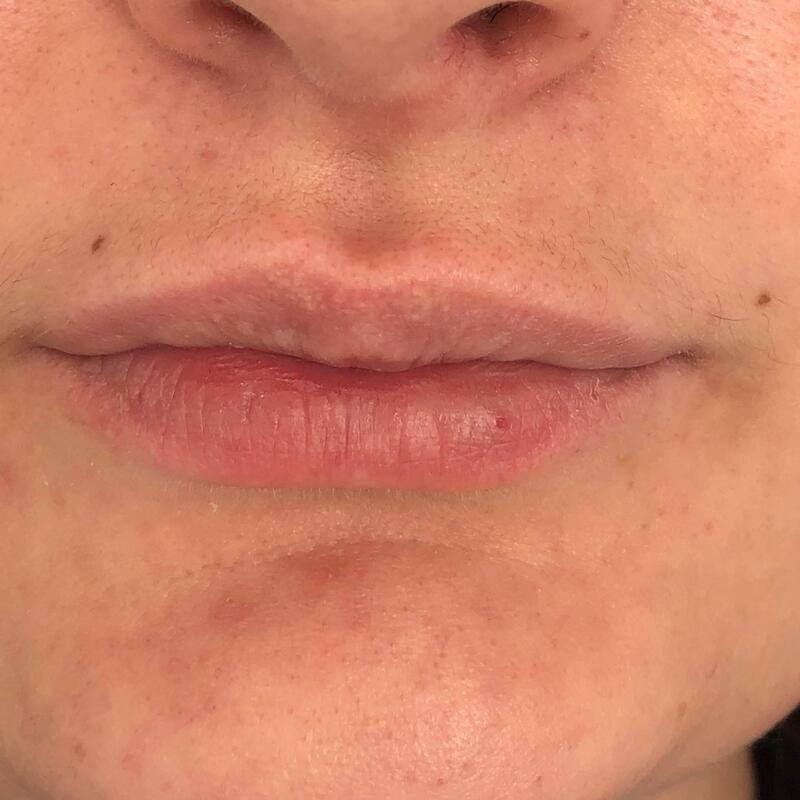 Lips Before & After Image