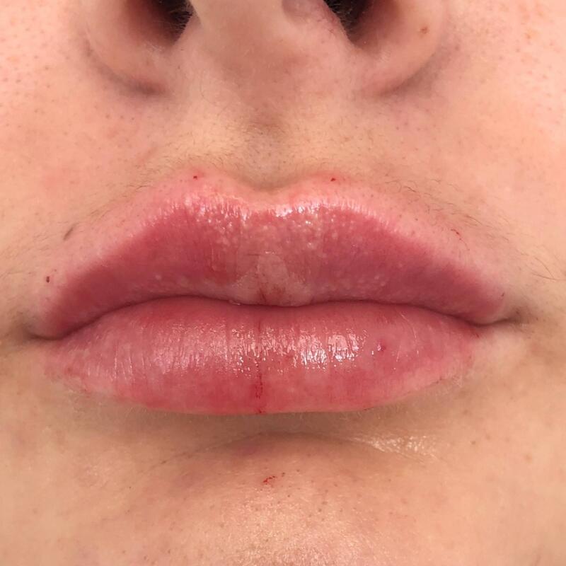 Lips Before & After Image