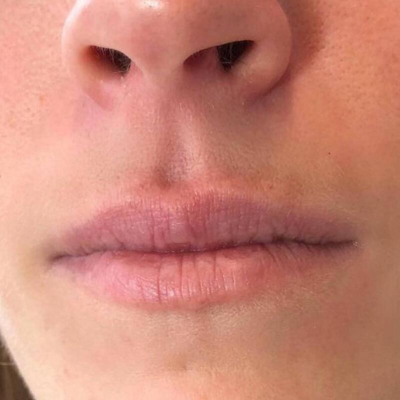 Lips Before & After Image