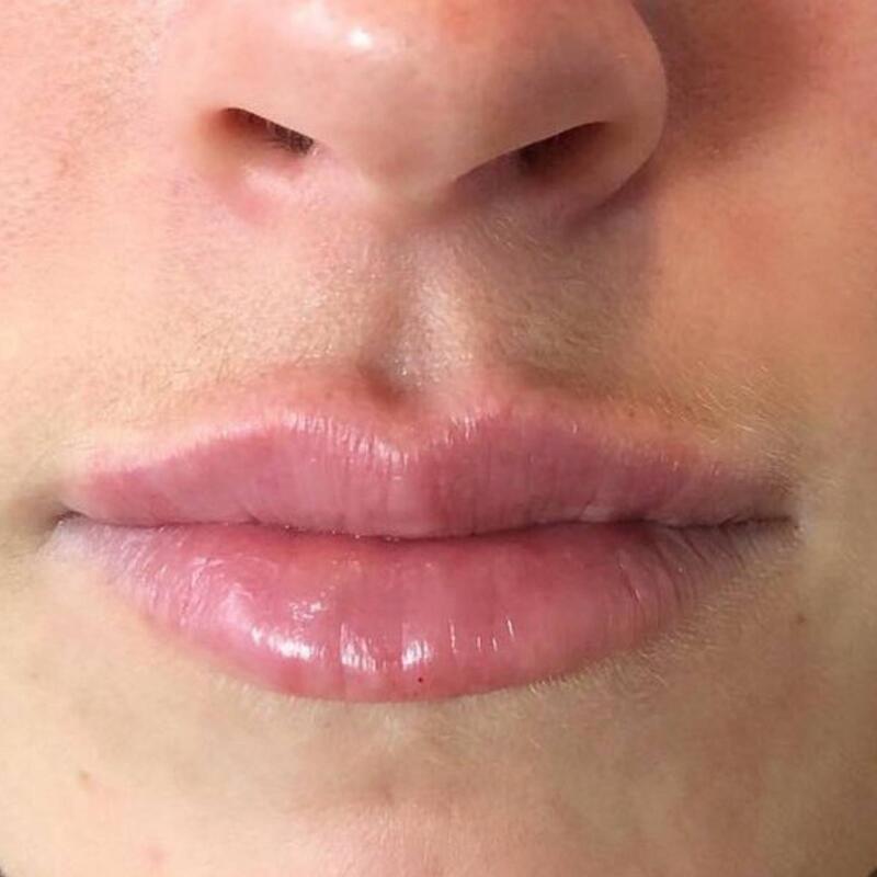 Lips Before & After Image