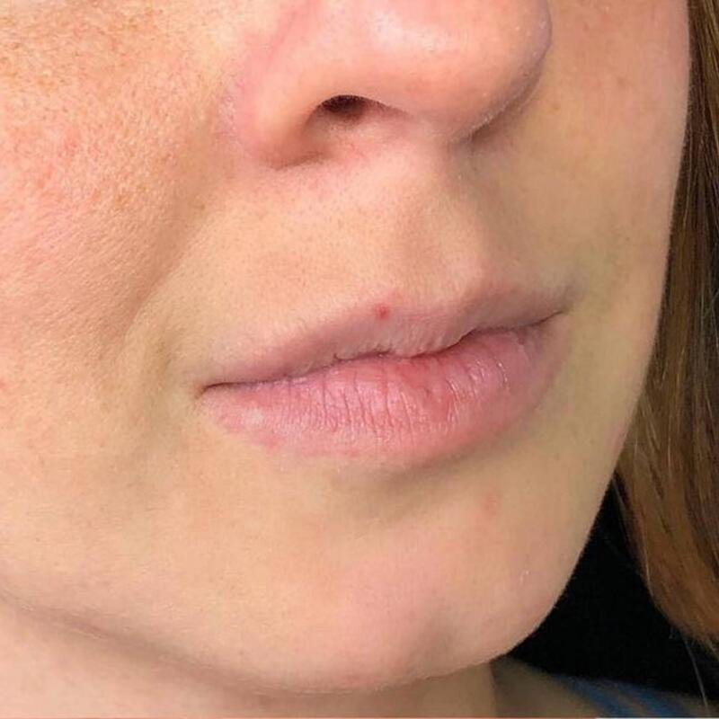 Lips Before & After Image
